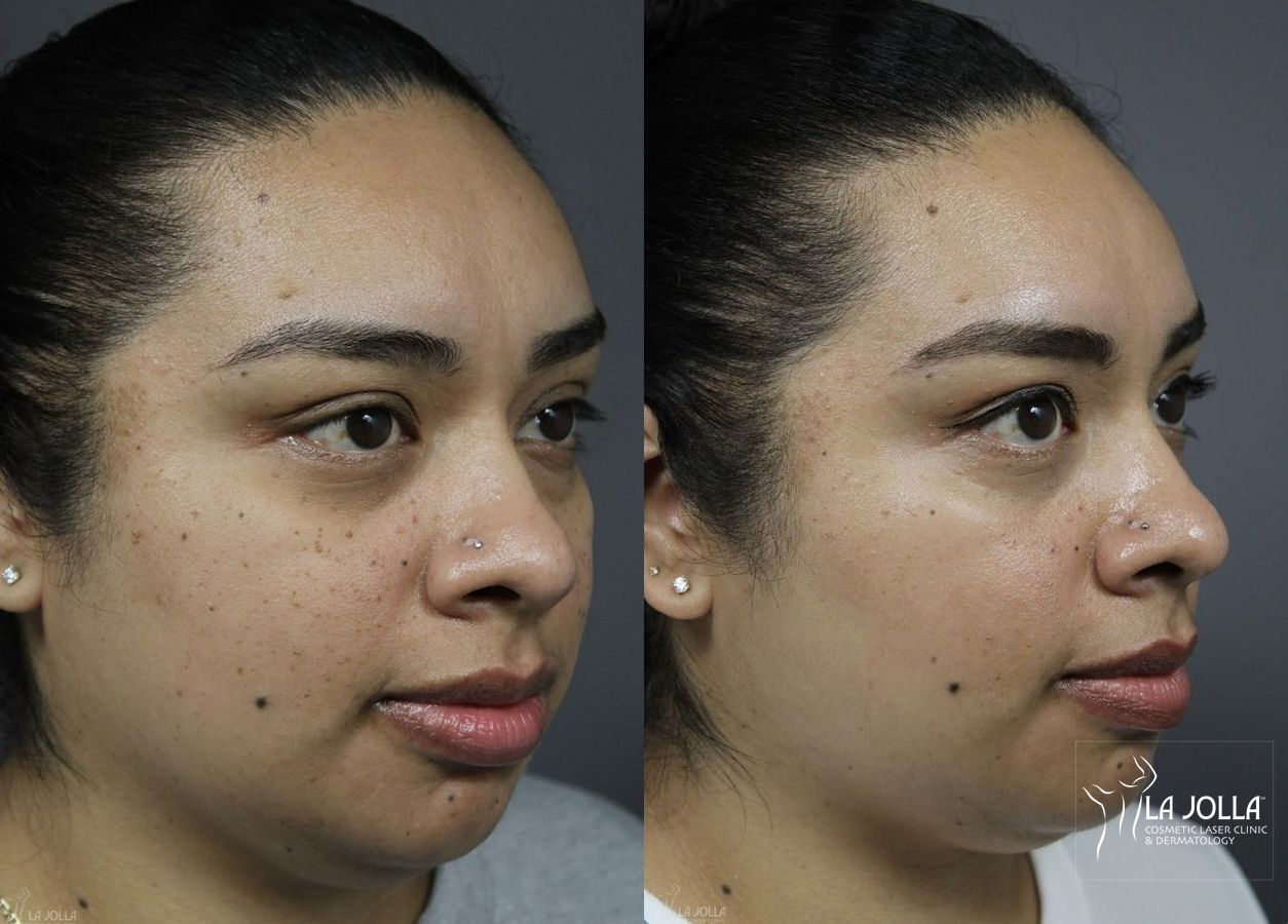 Before and after Dermatosis Papulosa Nigra (DPN) case 36382 - Angle 3