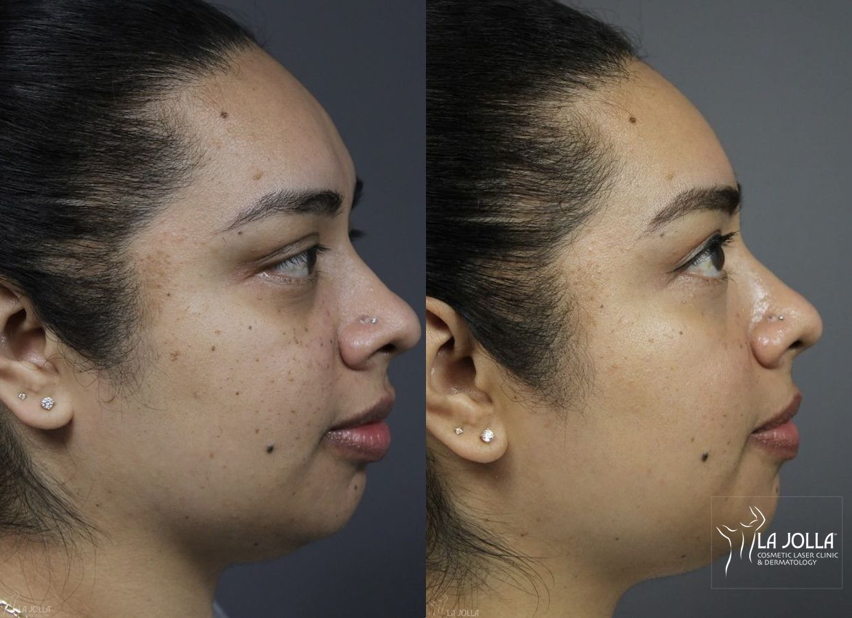 Before and after Dermatosis Papulosa Nigra (DPN) case 36382 - Angle 5