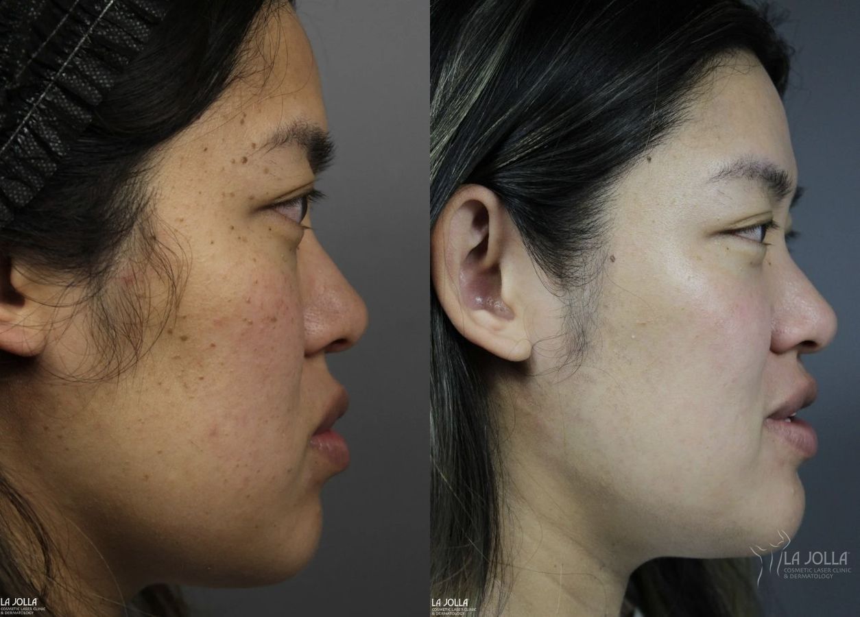 Before and after Dermatosis Papulosa Nigra (DPN) case 36393 - Angle 5