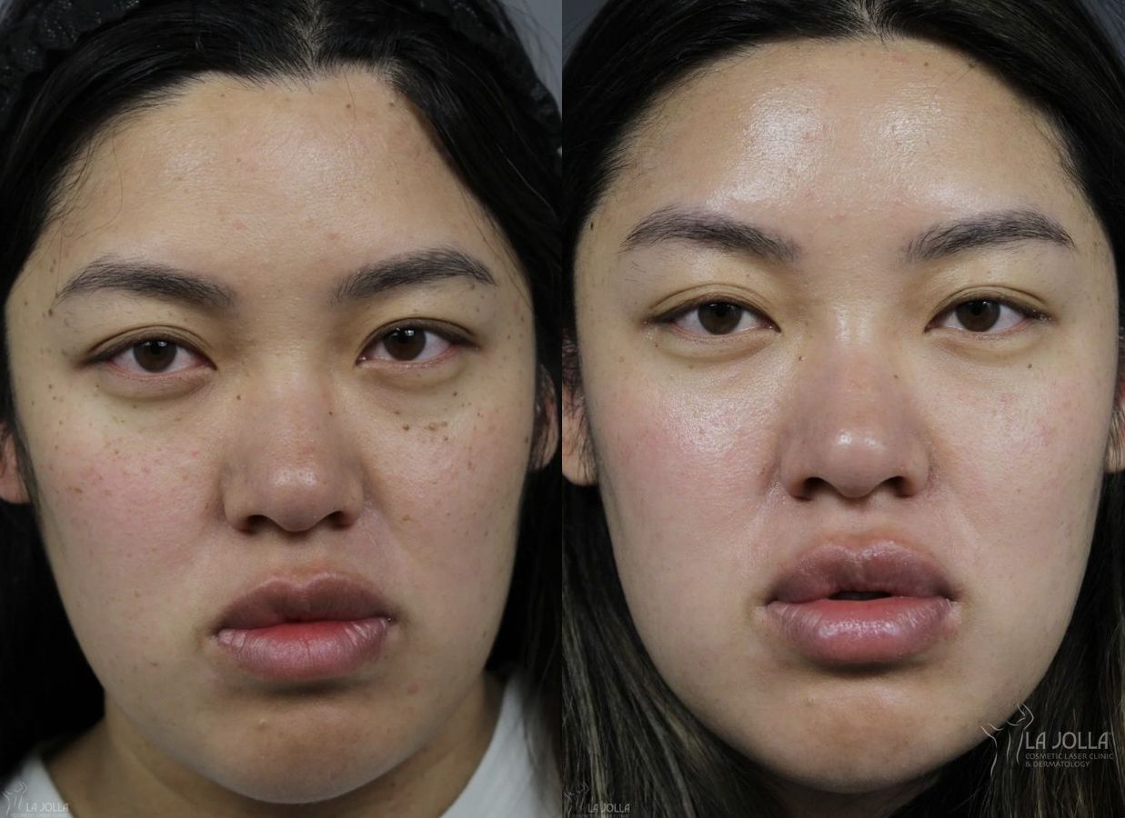 Before and after Dermatosis Papulosa Nigra (DPN) case 36393
