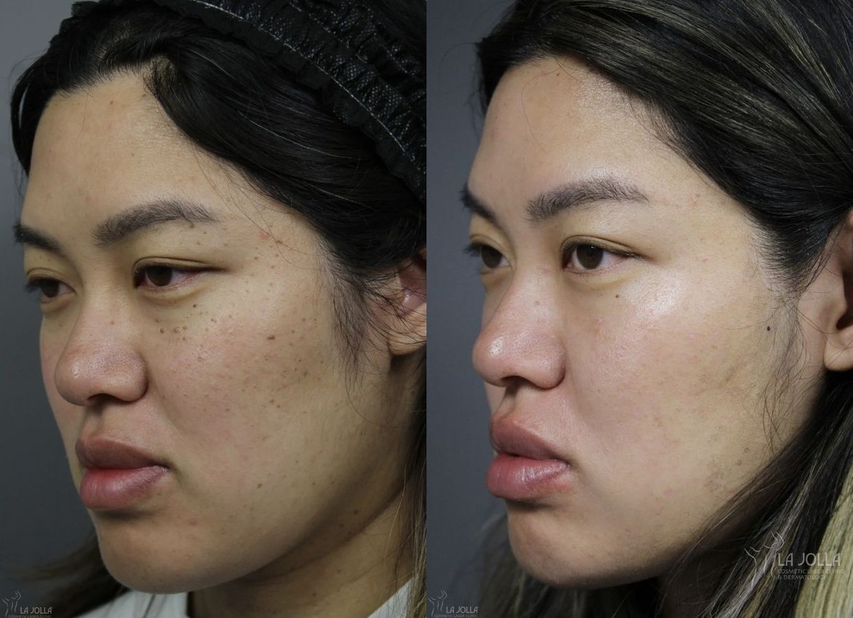 Before and after Dermatosis Papulosa Nigra (DPN) case 36393 - Angle 2
