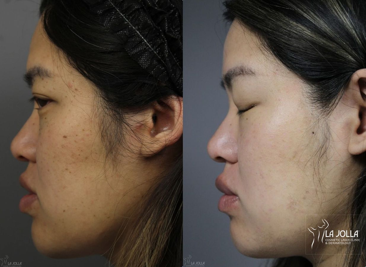 Before and after Dermatosis Papulosa Nigra (DPN) case 36393 - Angle 3