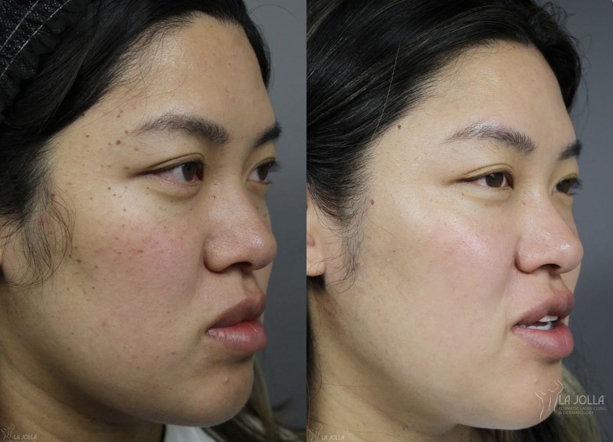 Before and after Dermatosis Papulosa Nigra (DPN) case 36393 - Angle 4