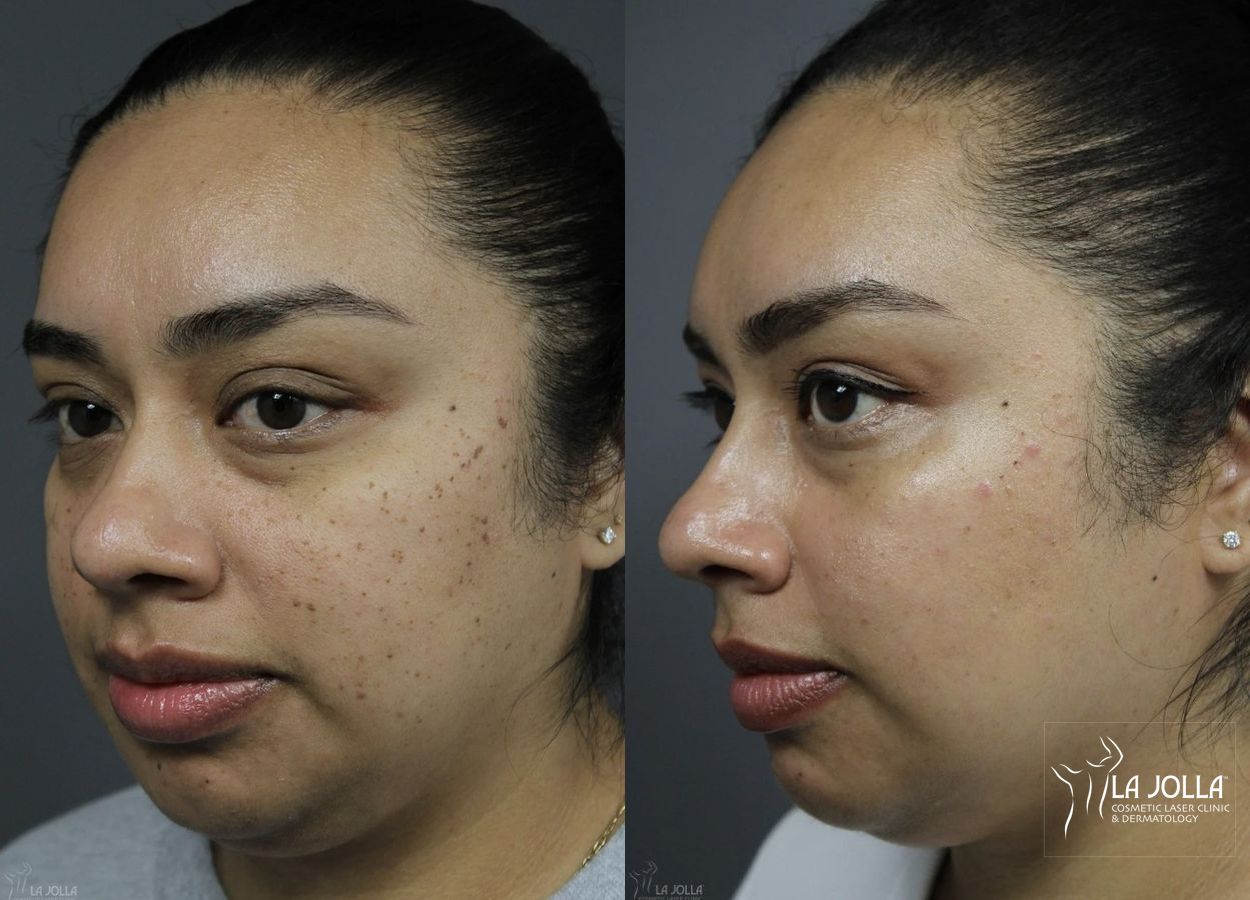 Before and after Dermatosis Papulosa Nigra (DPN) case 36382 - Angle 2