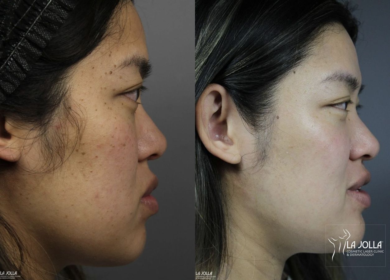 Before and after Dermatosis Papulosa Nigra (DPN) case 36393 - Angle 5