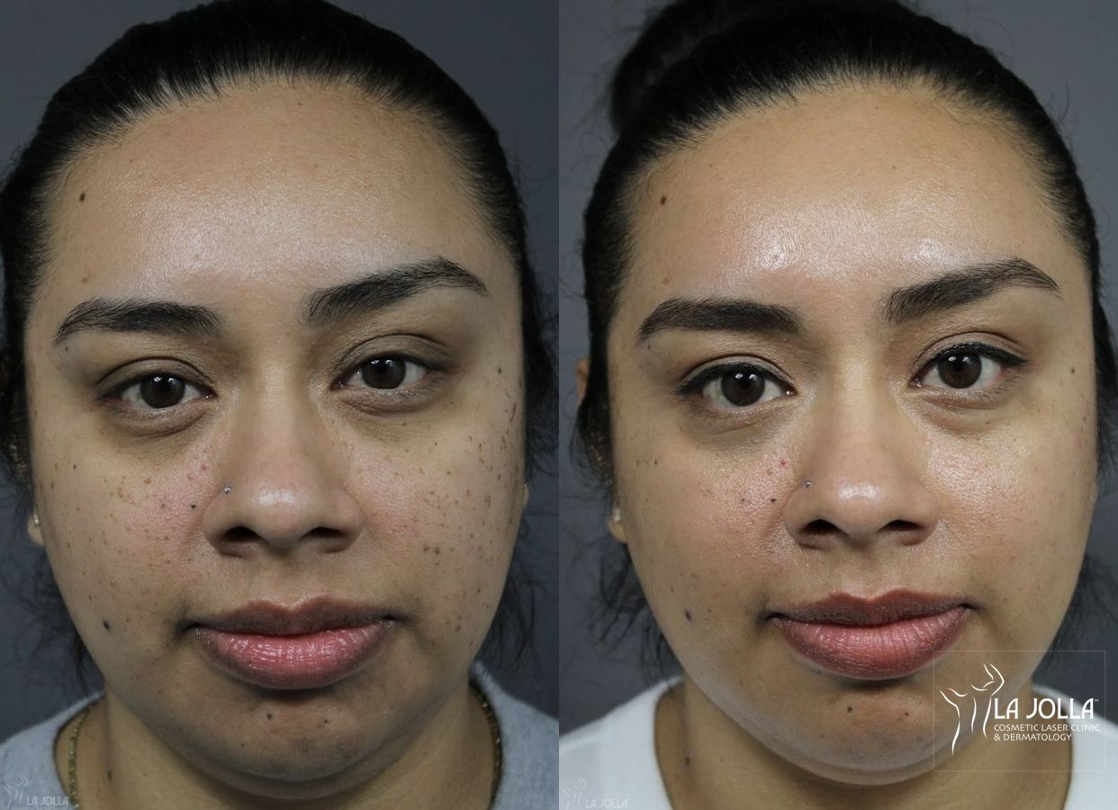 Before and after Dermatosis Papulosa Nigra (DPN) case 36382
