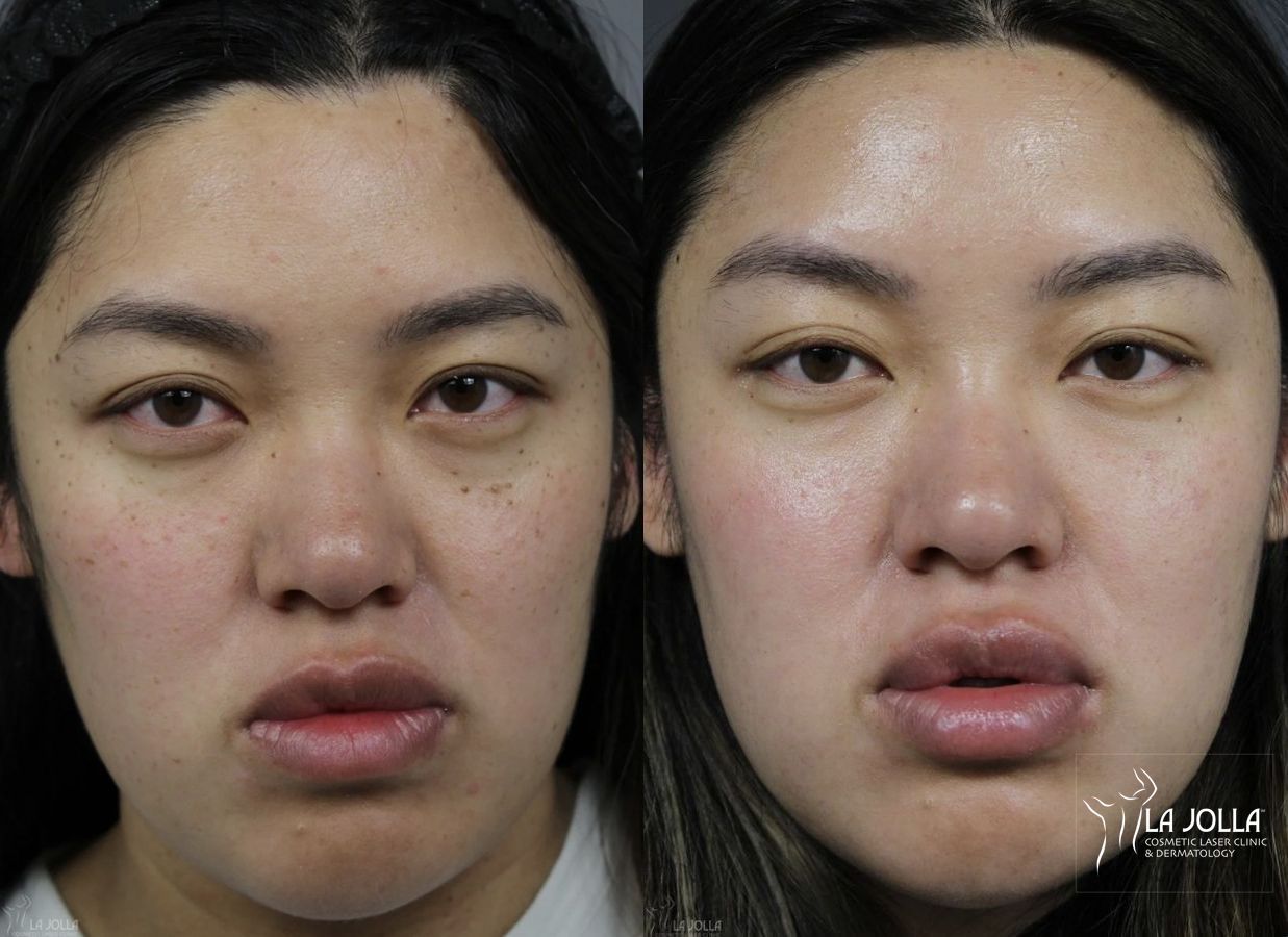 Before and after Dermatosis Papulosa Nigra (DPN) case 36393