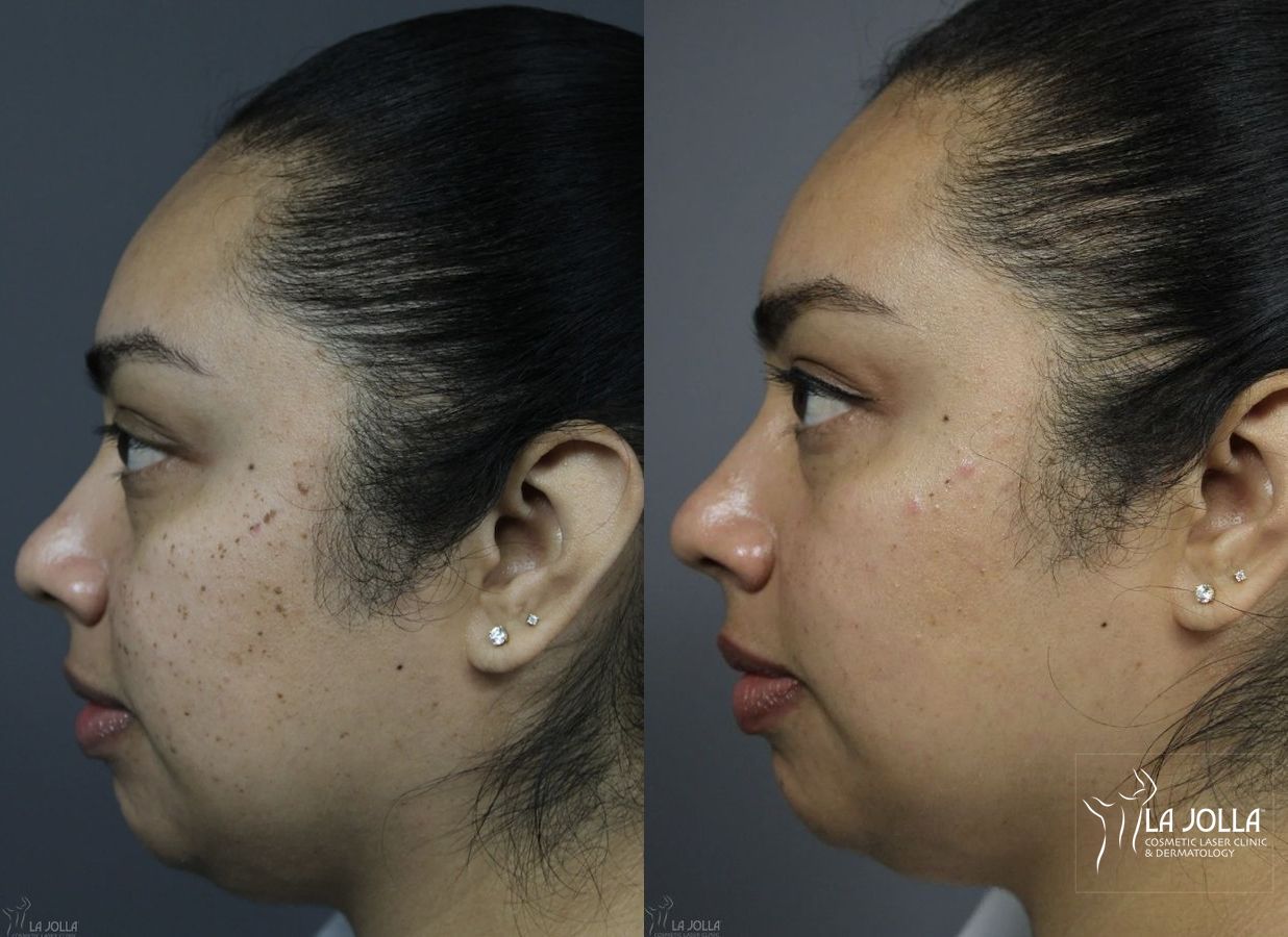 Before and after Dermatosis Papulosa Nigra (DPN) case 36382 - Angle 4