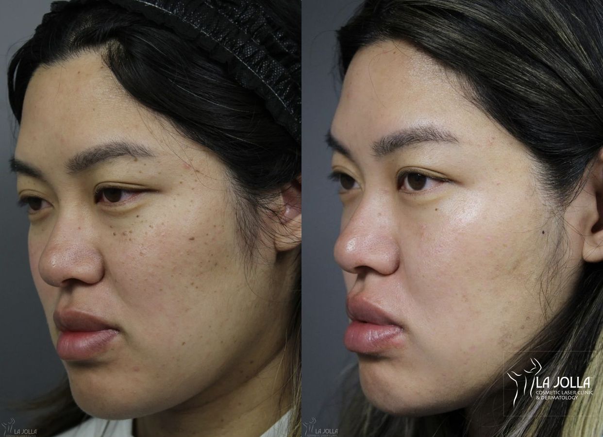 Before and after Dermatosis Papulosa Nigra (DPN) case 36393 - Angle 2