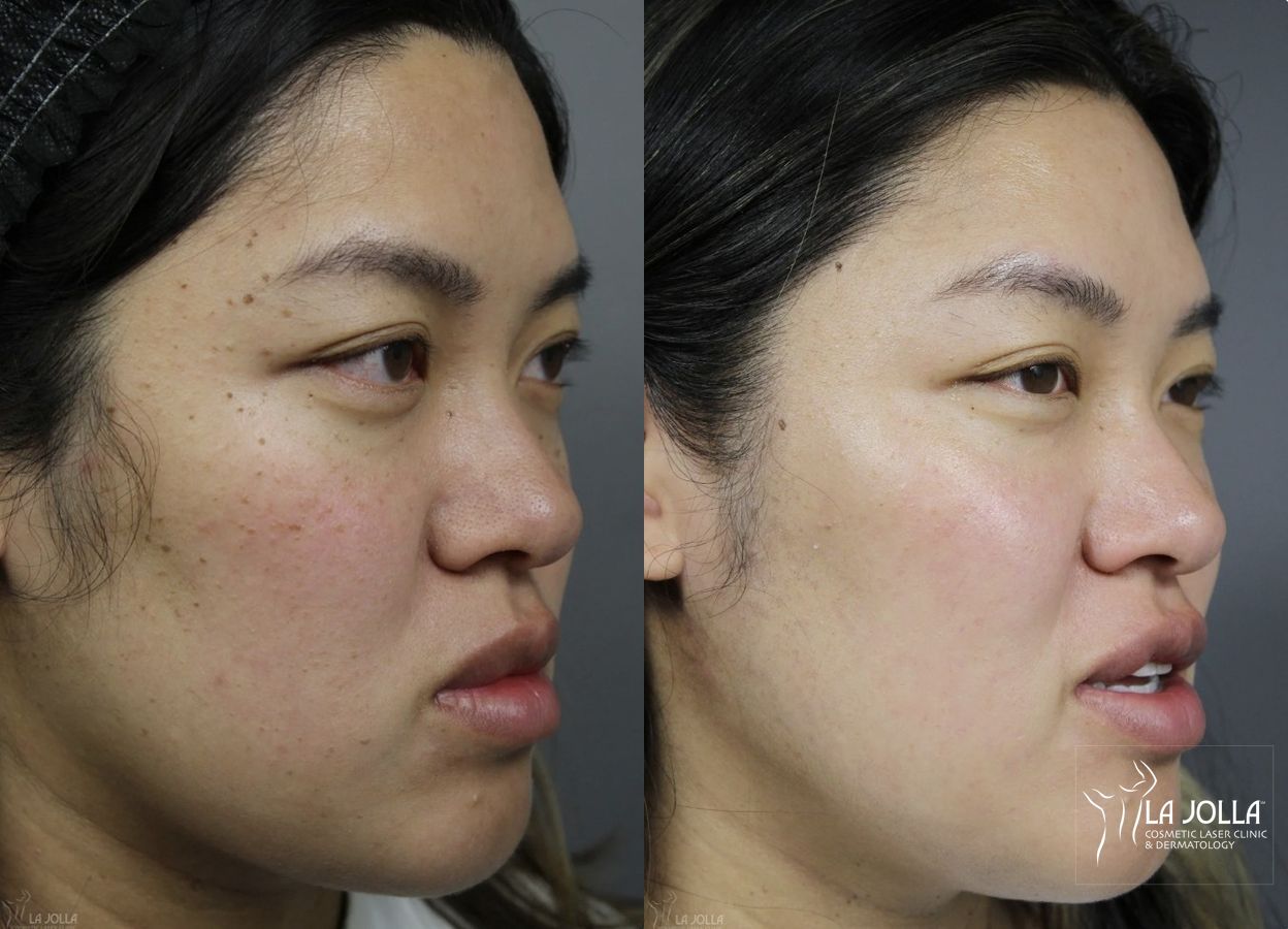 Before and after Dermatosis Papulosa Nigra (DPN) case 36393 - Angle 4