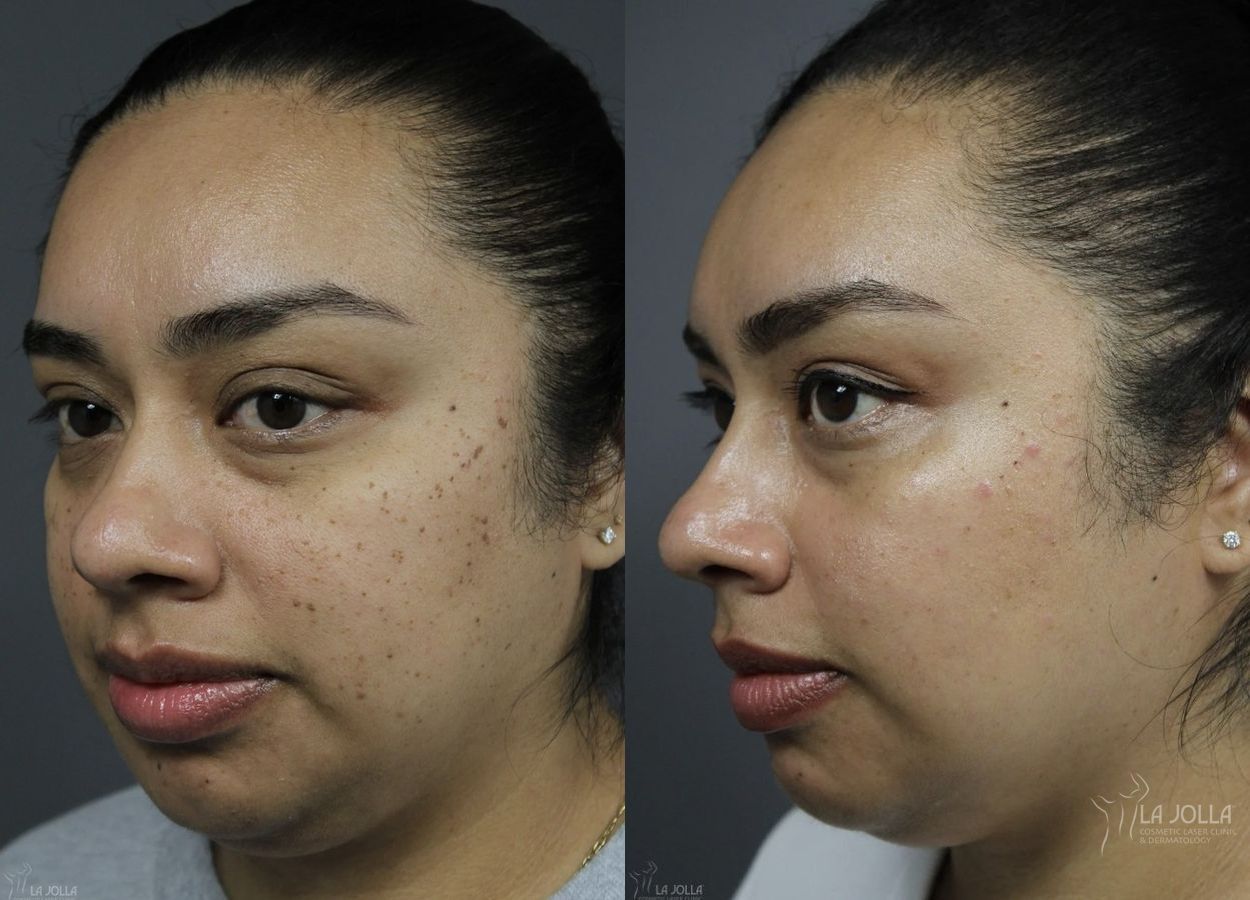 Before and after Dermatosis Papulosa Nigra (DPN) case 36382 - Angle 2