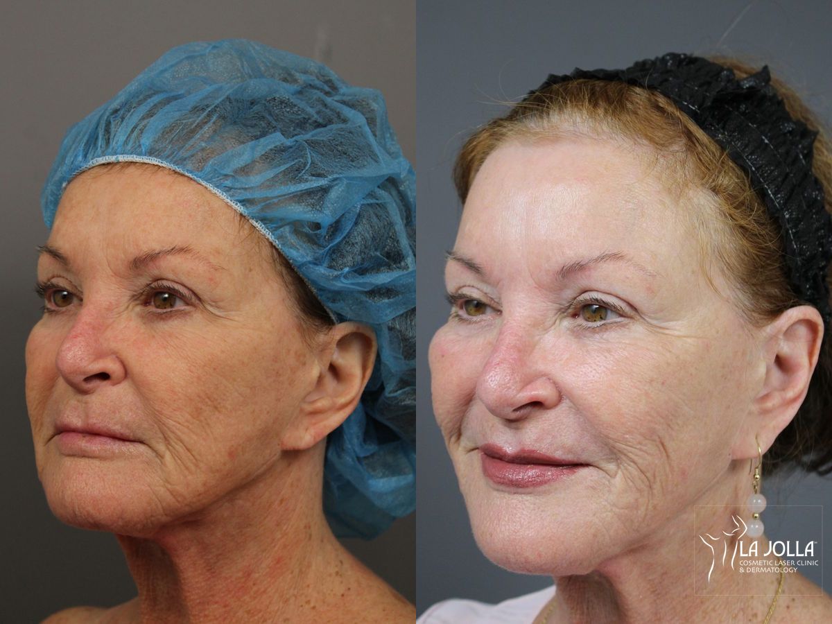 Before and after Fractional CO2 case 36075 - Angle 2