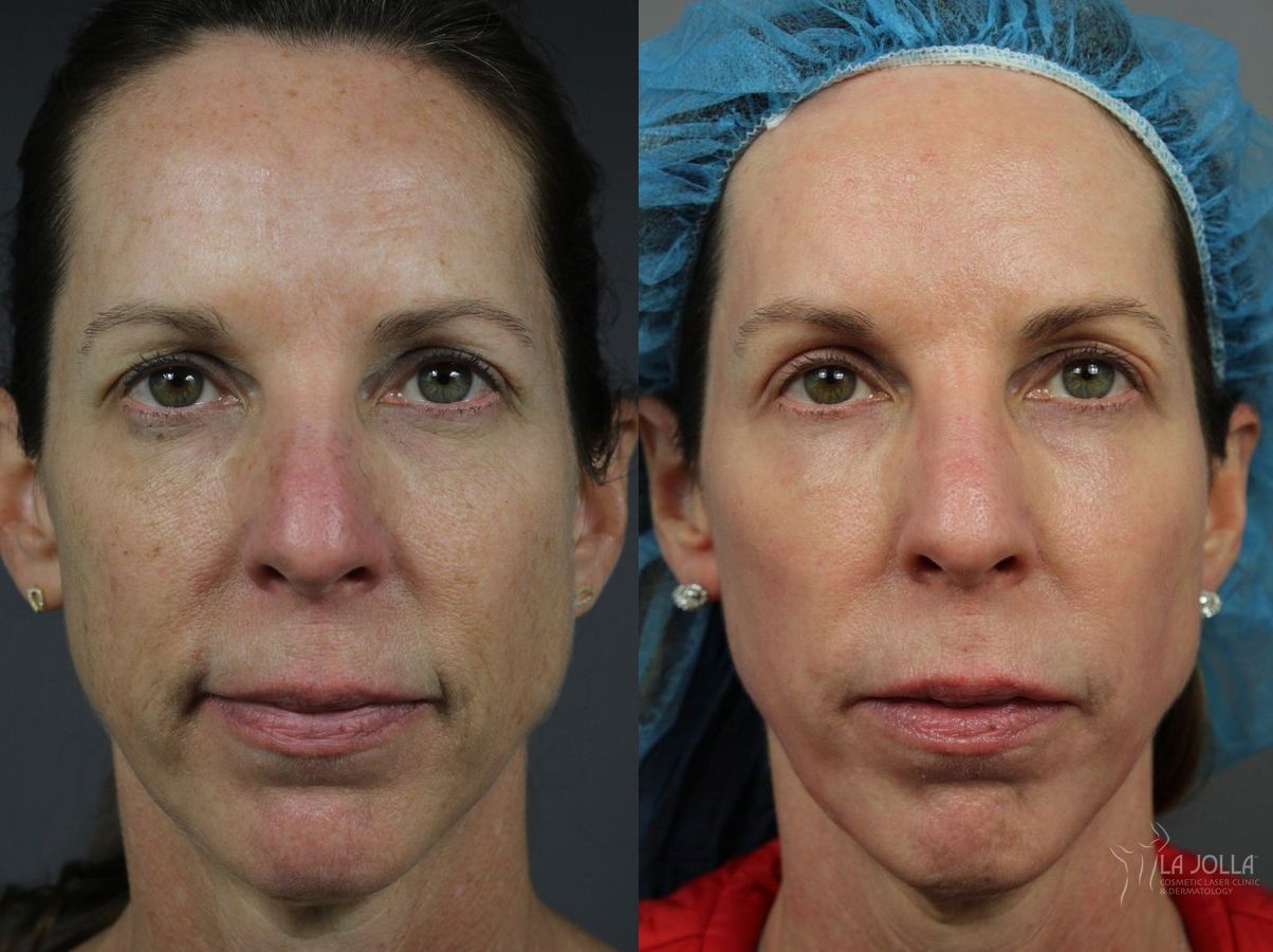 Before and after Fractional CO2 case 36316