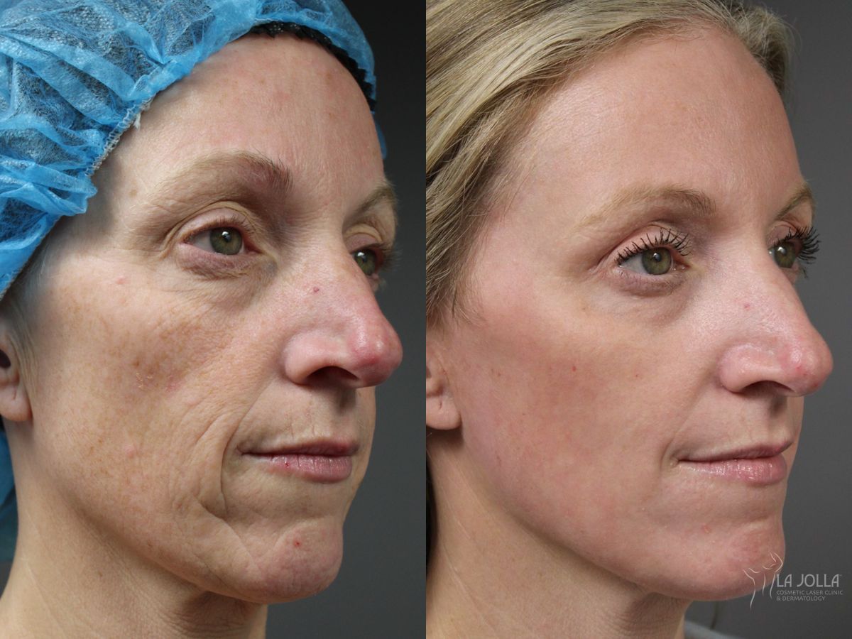 Before and after Fractional CO2 case 41767 - Angle 2