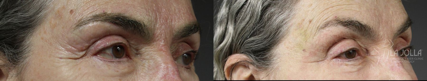 Before and after Fractional CO2 case 36402 - Angle 3