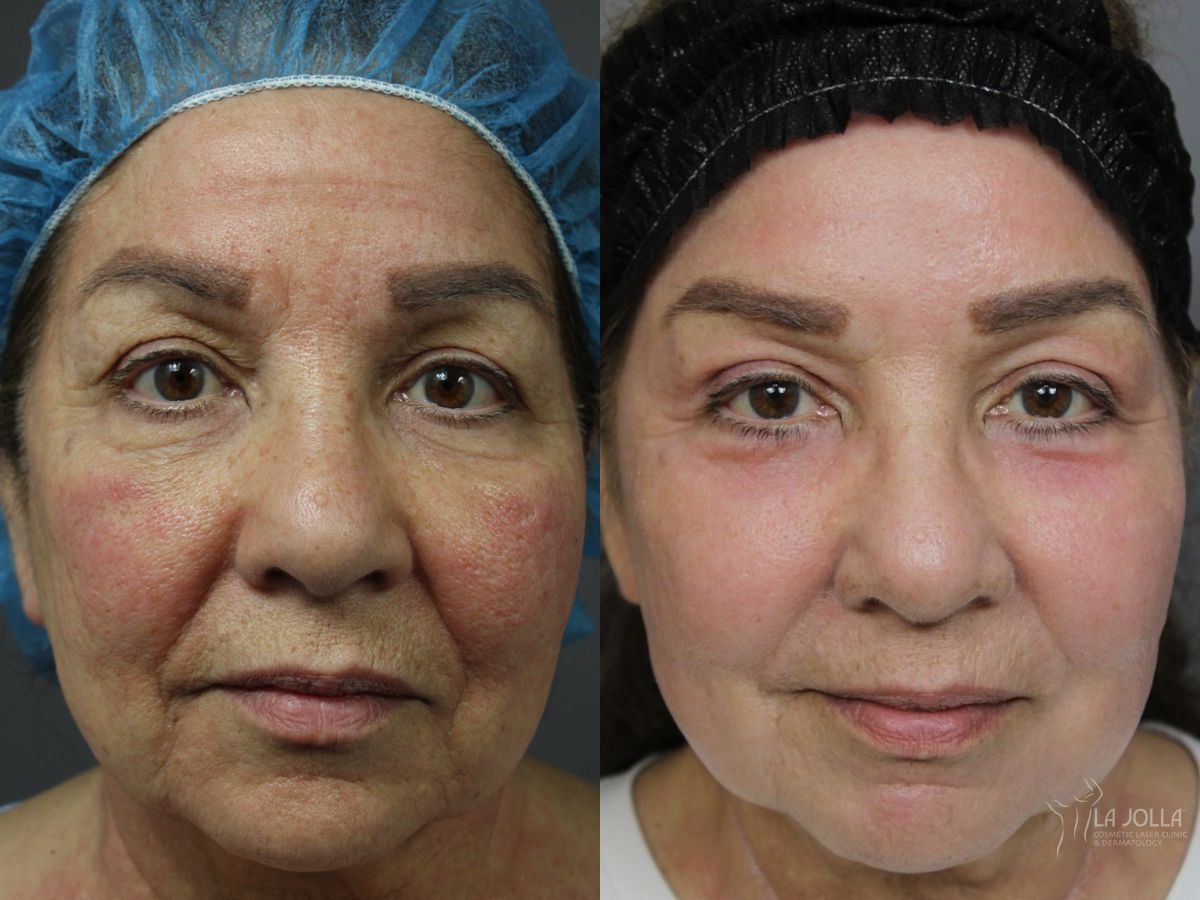 Before and after Ablative Laser Treatment case 46319