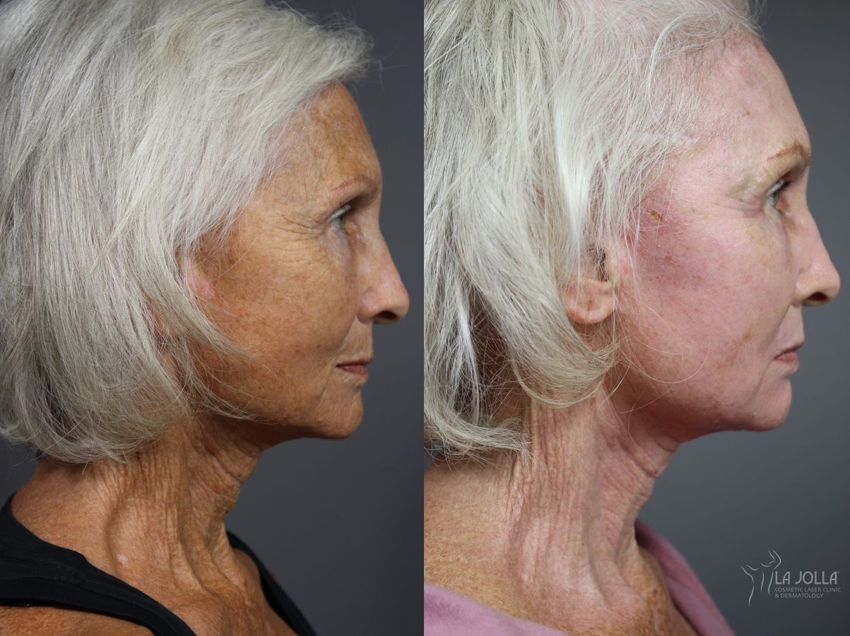 Before and after Fractional CO2 case 36122 - Angle 3