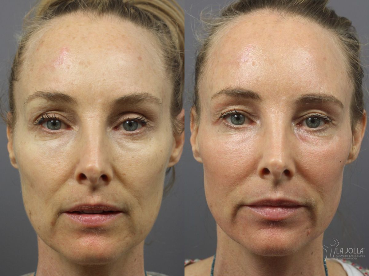 Before and after Fractional CO2 case 36344