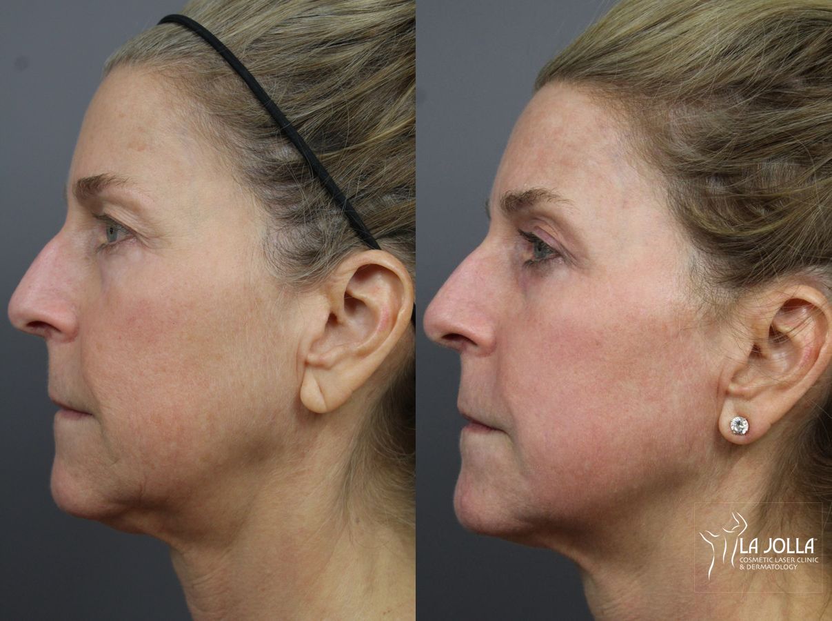 Before and after Fractional CO2 case 36184 - Angle 2