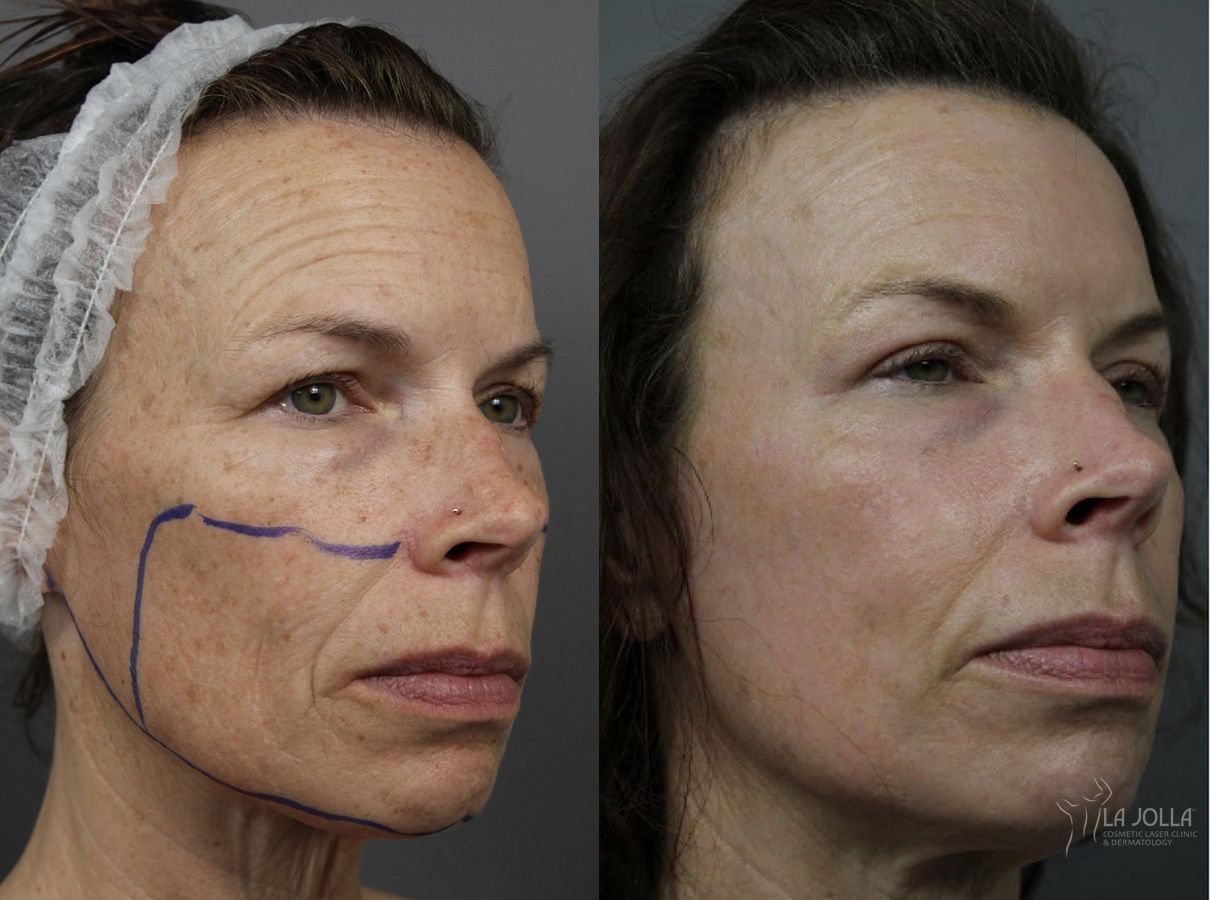 Before and after Fractional CO2 case 36148