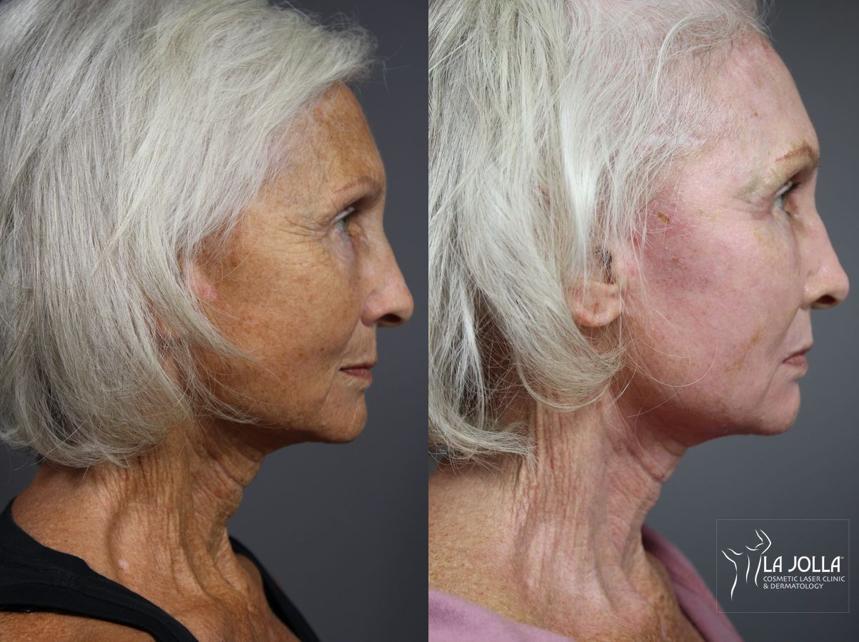 Before and after Fractional CO2 case 36122 - Angle 3