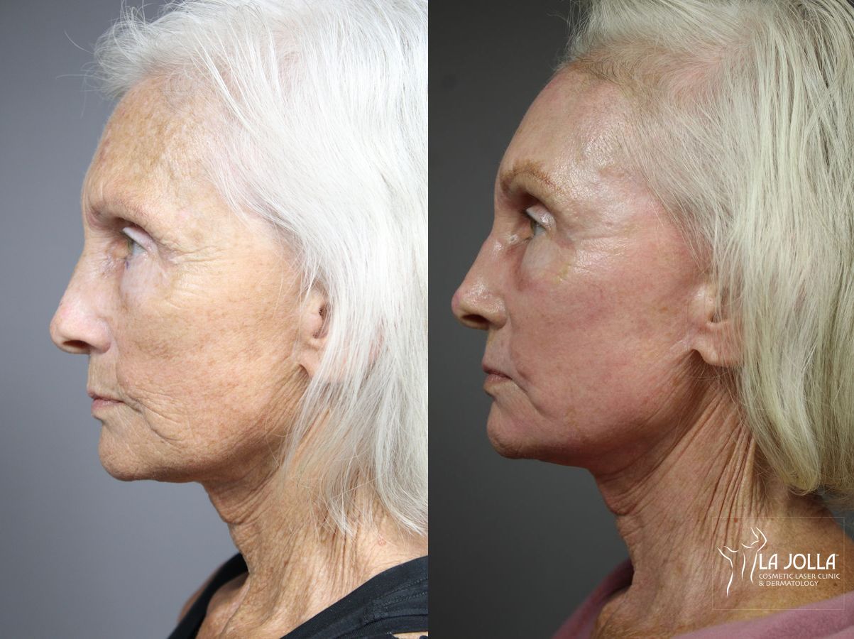 Before and after Fractional CO2 case 36122 - Angle 2