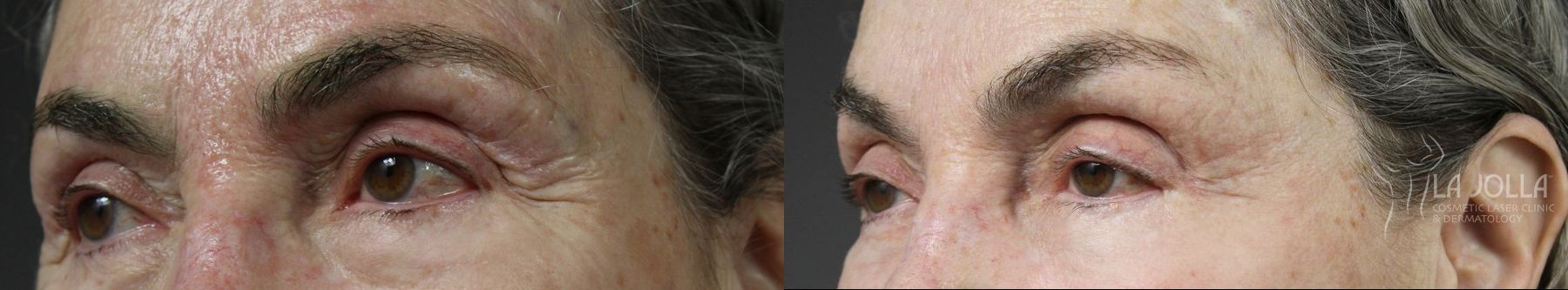 Before and after Fractional CO2 case 36402 - Angle 2