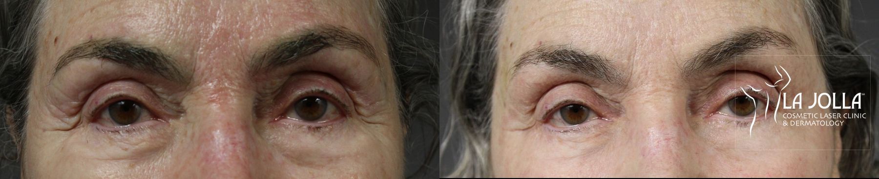 Before and after Fractional CO2 case 36402