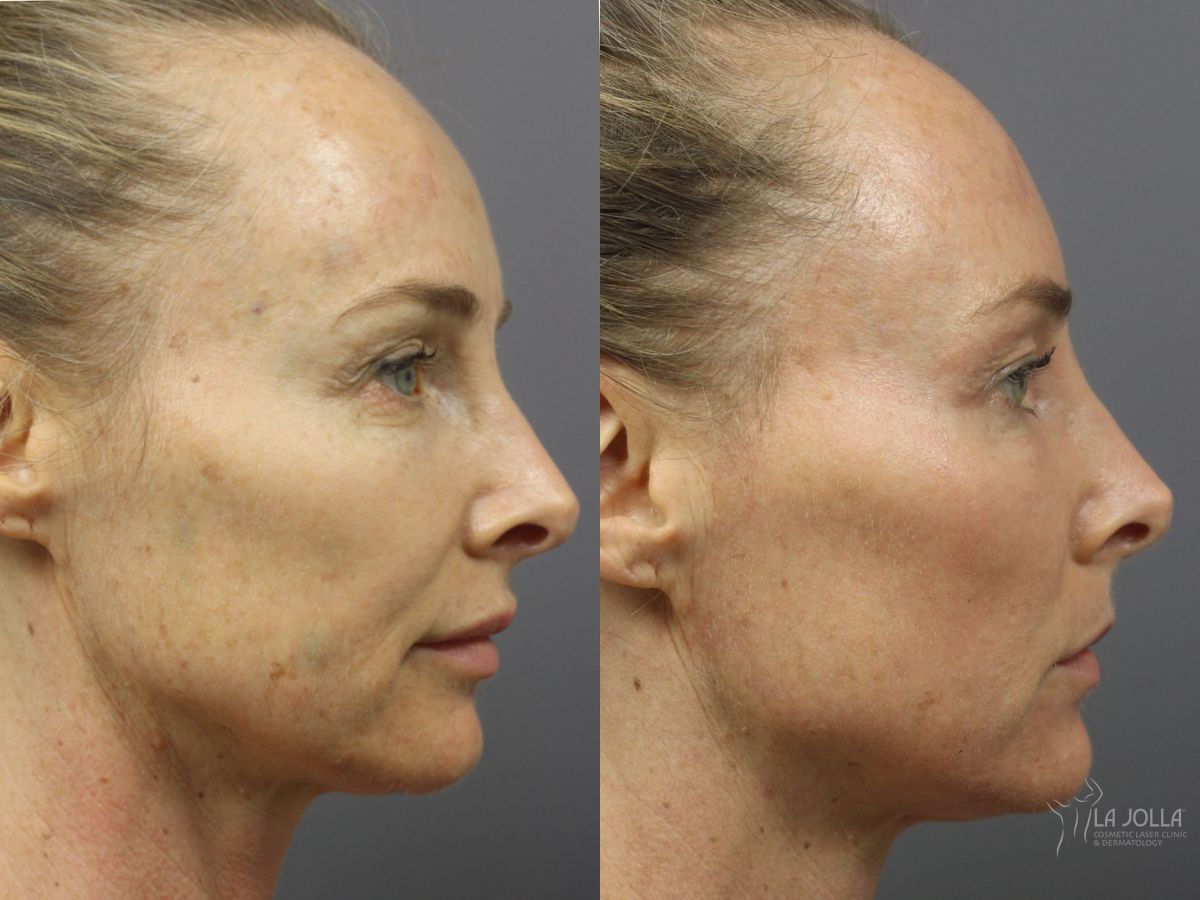 Before and after Fractional CO2 case 36344 - Angle 2
