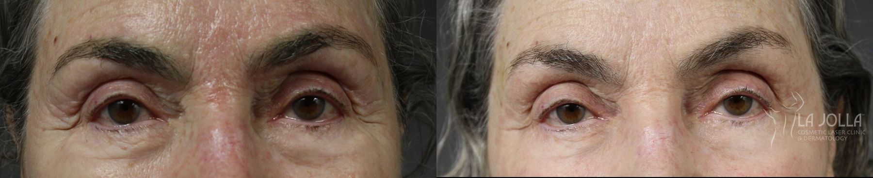 Before and after Fractional CO2 case 36402
