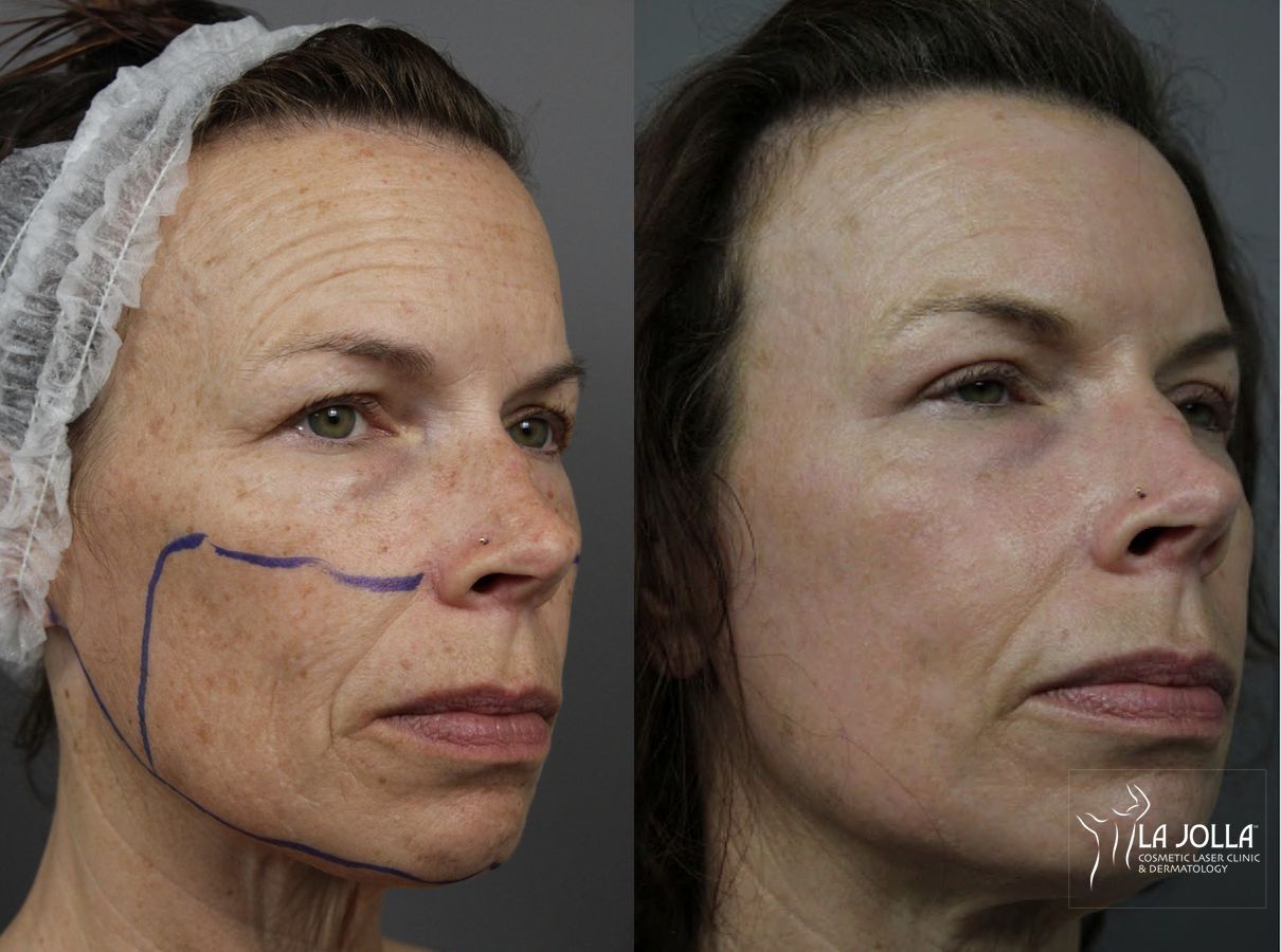Before and after Fractional CO2 case 36148