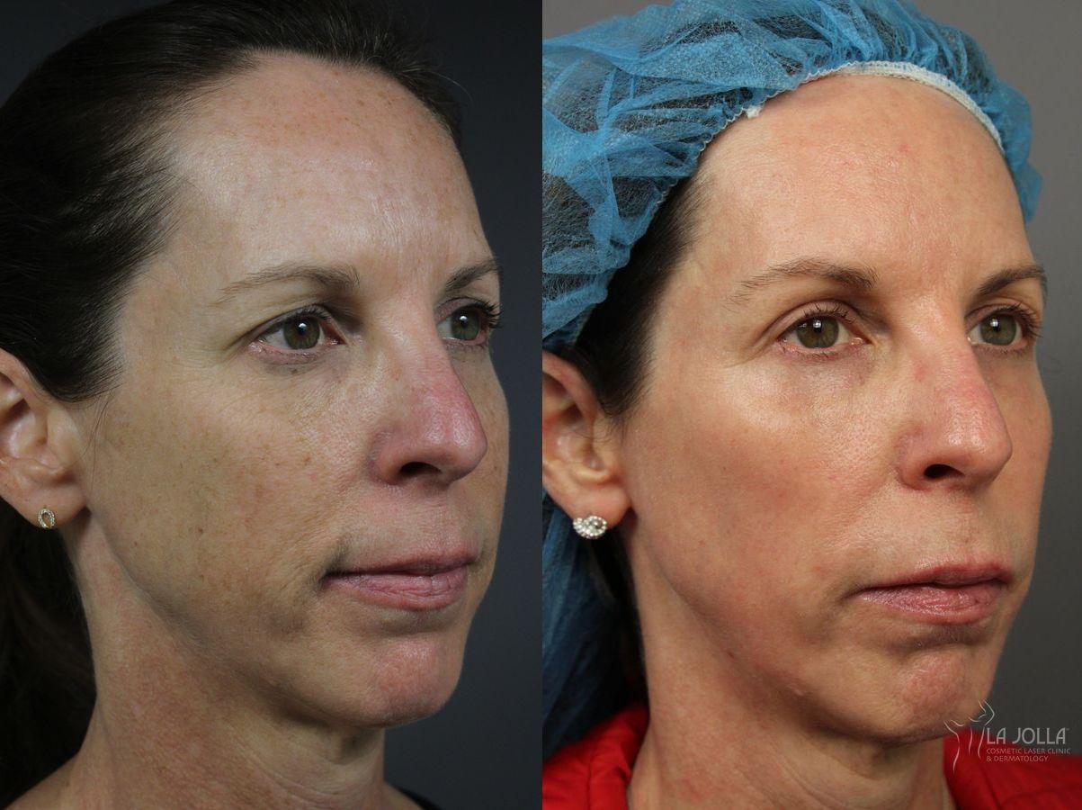 Before and after Fractional CO2 case 36316 - Angle 2