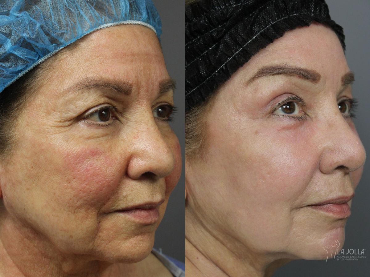 Before and after Ablative Laser Treatment case 46319 - Angle 2