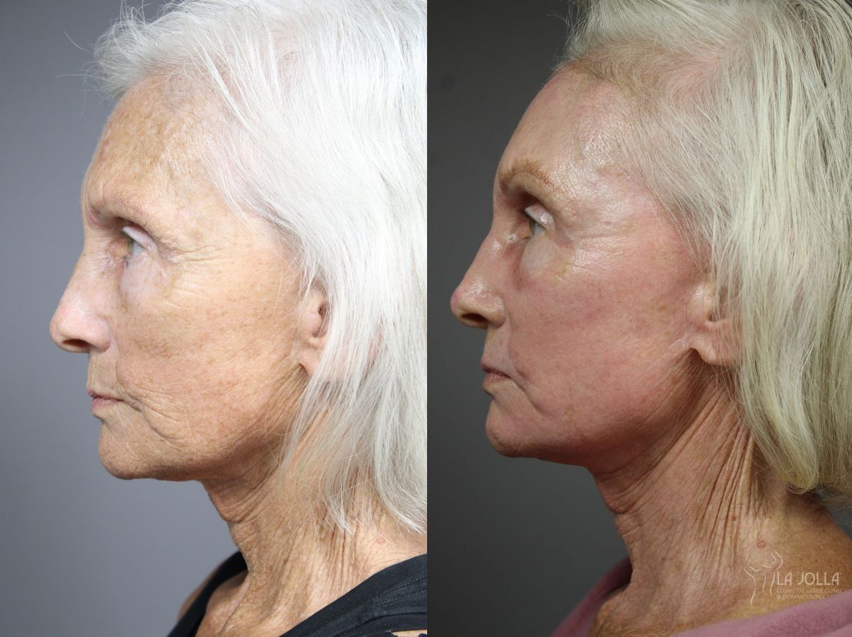 Before and after Fractional CO2 case 36122 - Angle 2