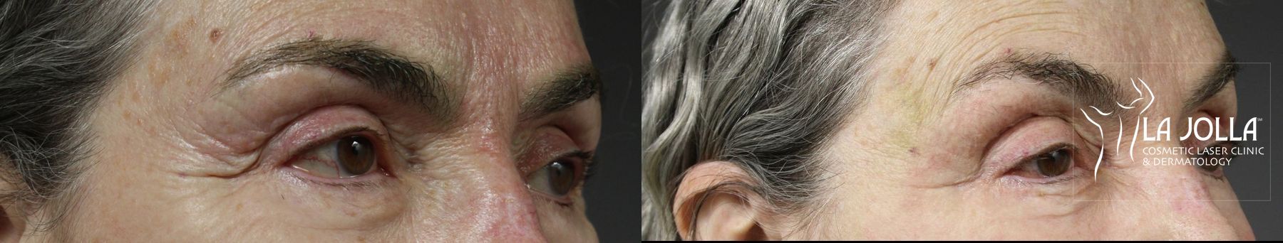 Before and after Fractional CO2 case 36402 - Angle 3