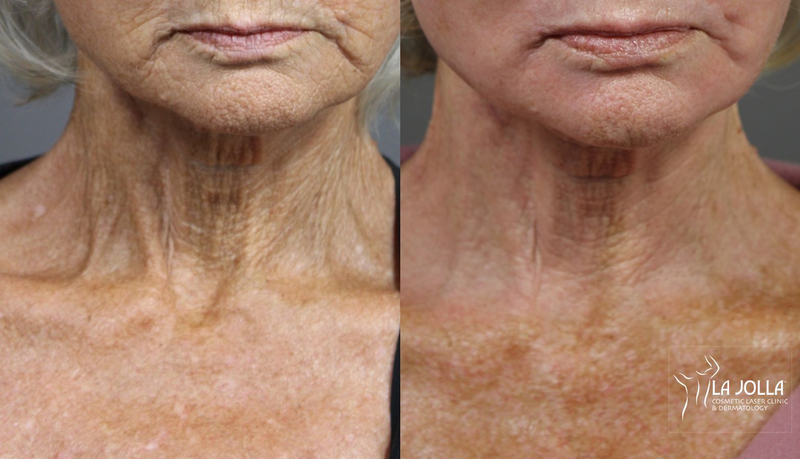 Before and after Fractional CO2 case 36122 - Angle 4