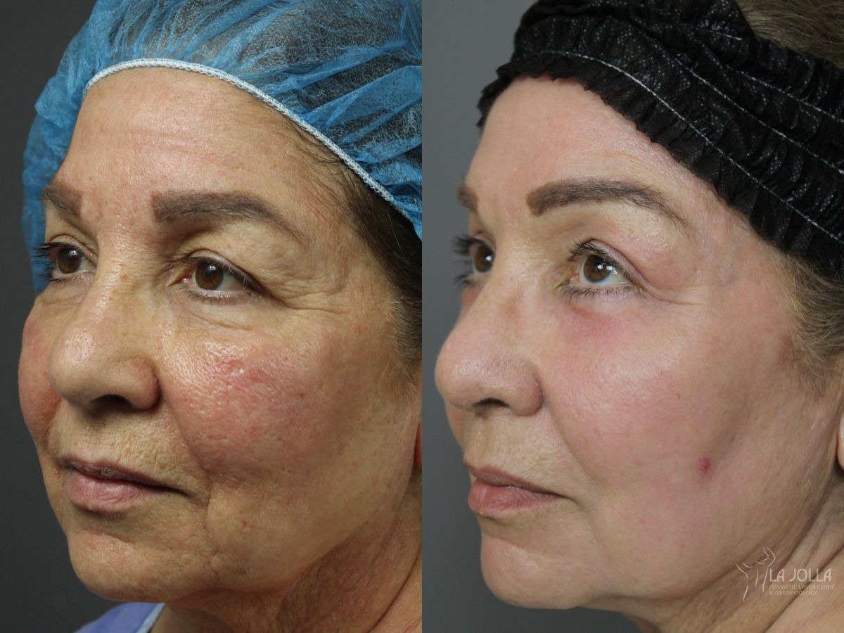 Before and after Ablative Laser Treatment case 46319 - Angle 3