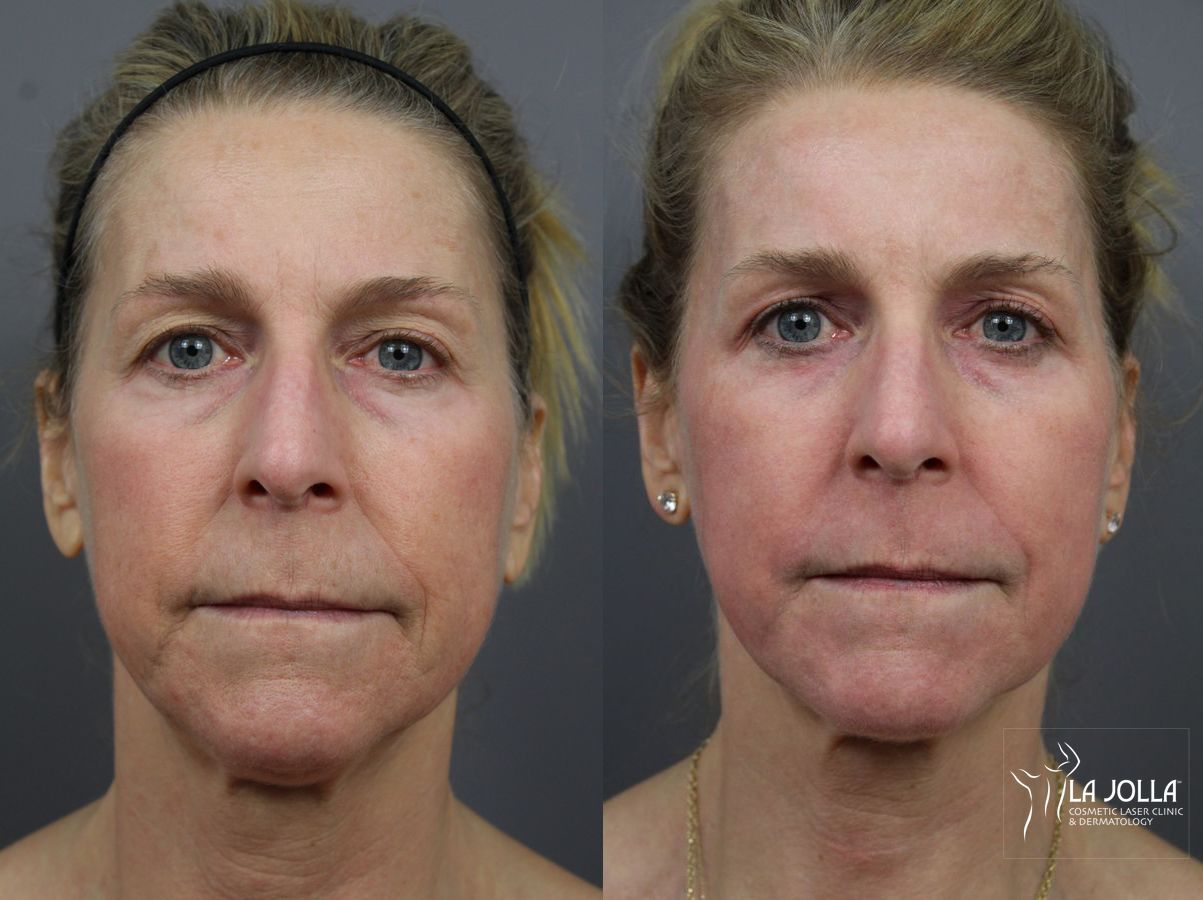 Before and after Fractional CO2 case 36184