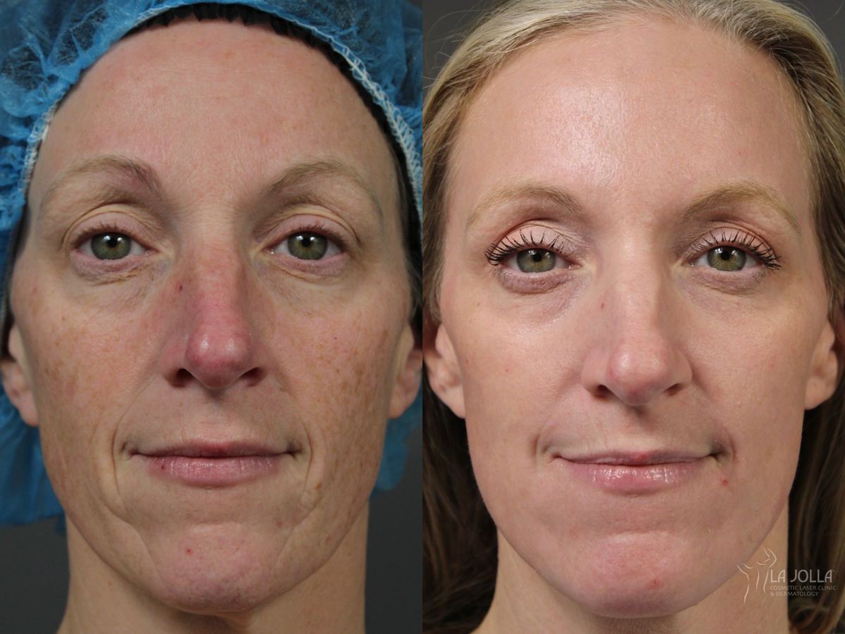 Before and after Fractional CO2 case 41767