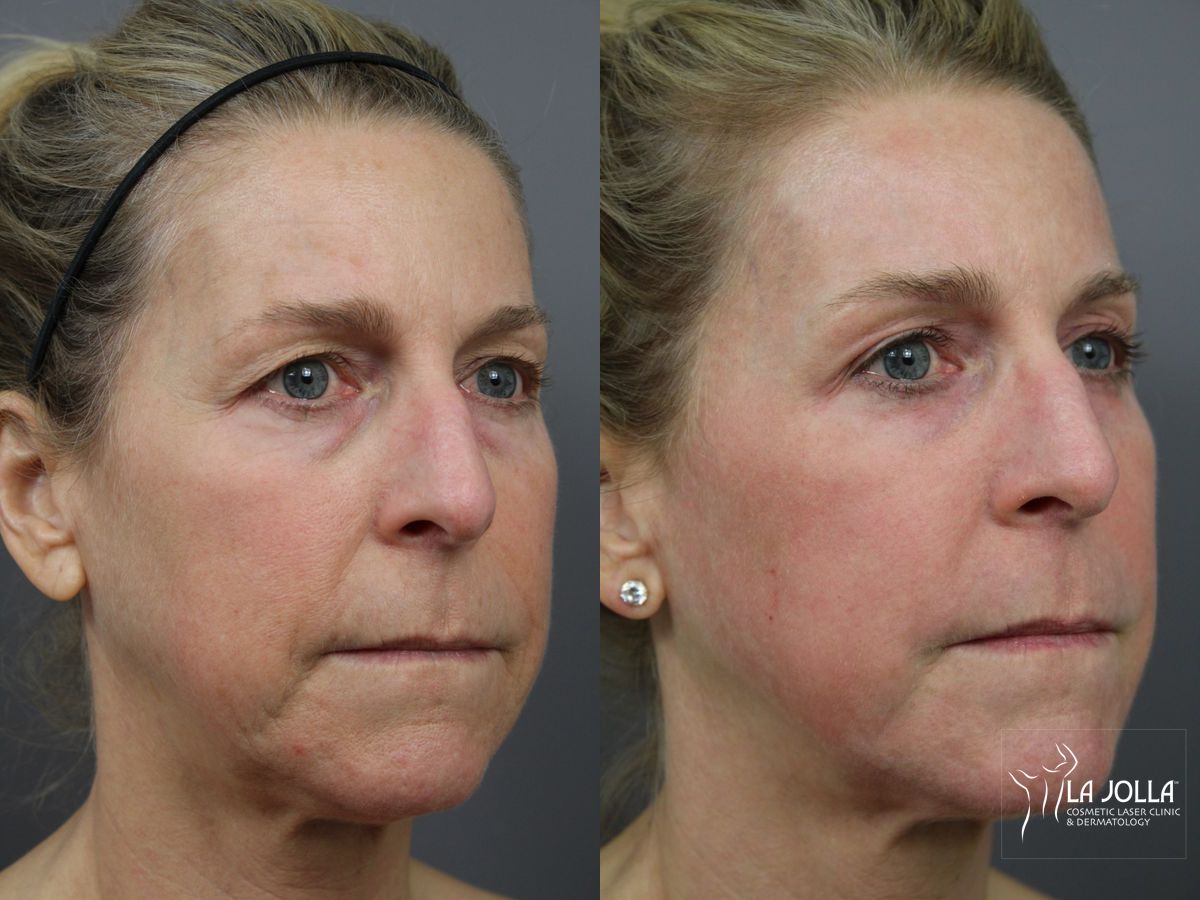 Before and after Fractional CO2 case 36184 - Angle 3