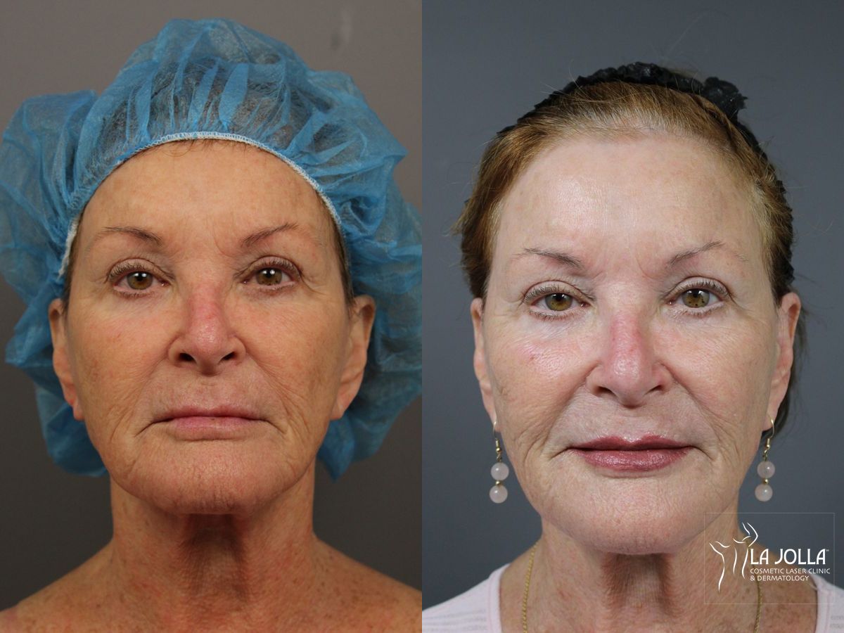 Before and after Fractional CO2 case 36075