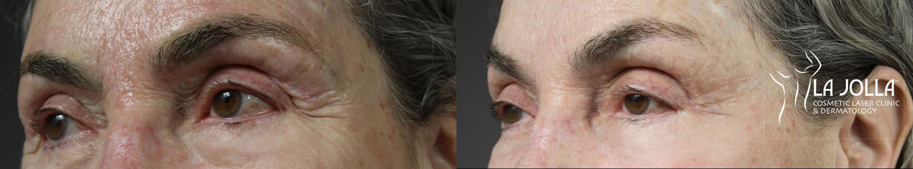 Before and after Fractional CO2 case 36402 - Angle 2