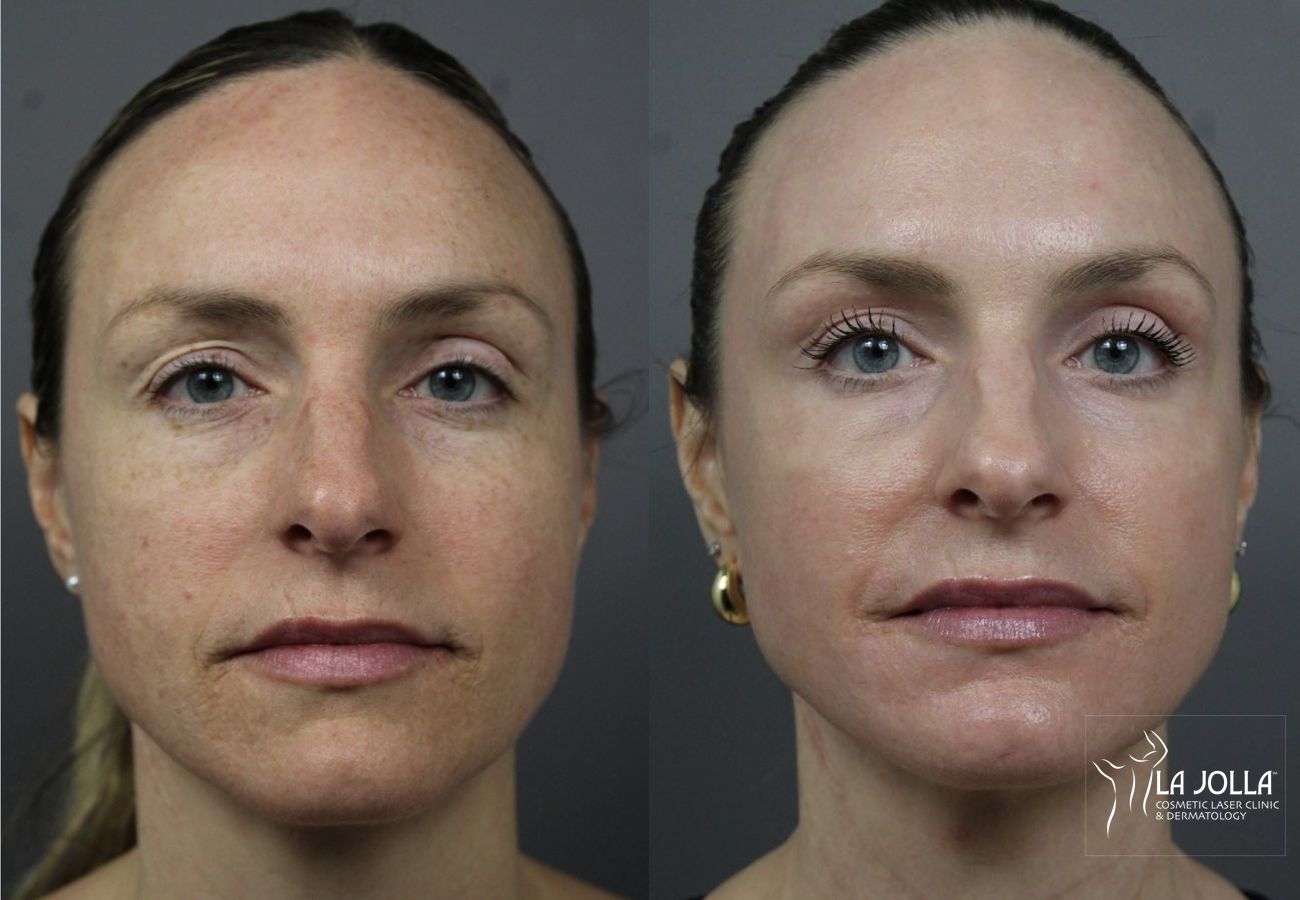 Before and after Fractional CO2 case 36135