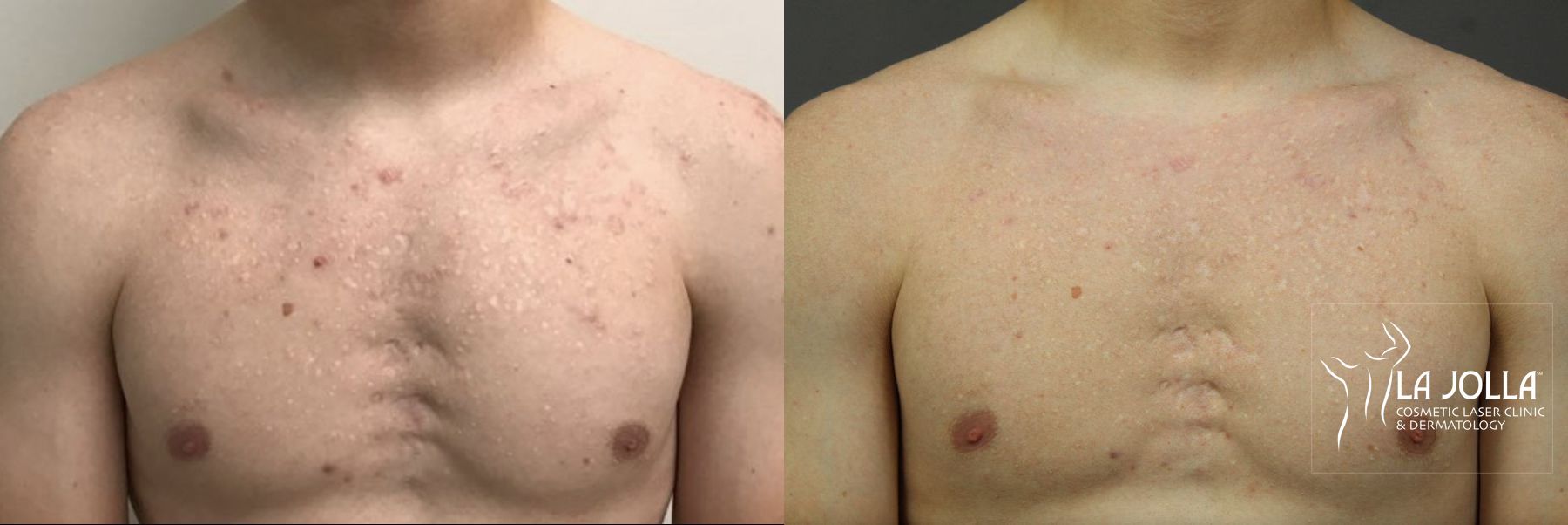 Fraxel Scar Before and After