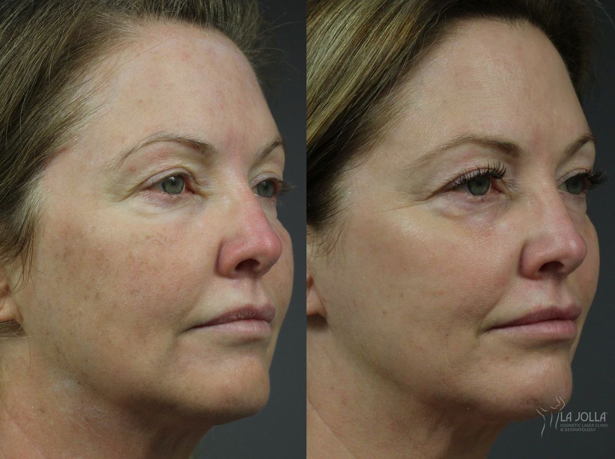 Before and after Fraxel® case 36261 - Angle 2