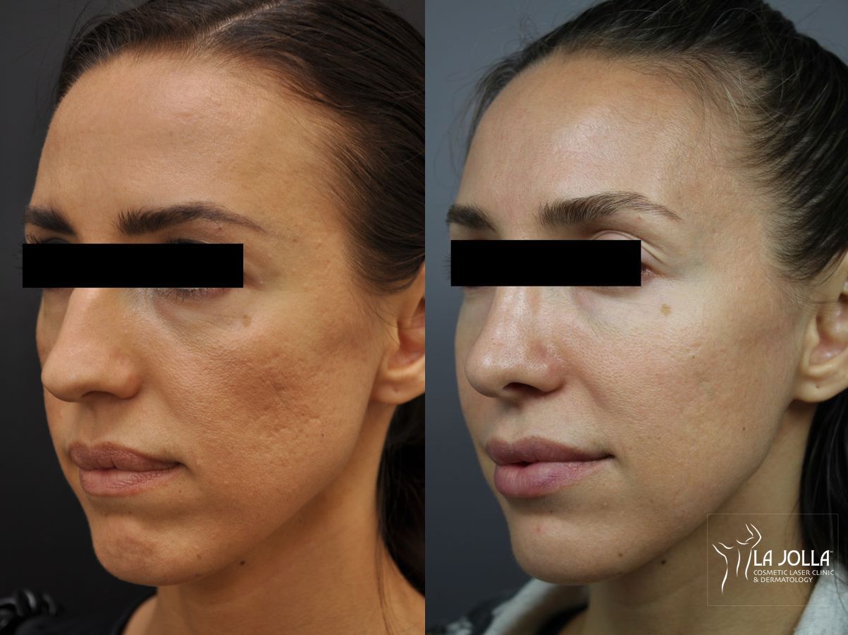 Before and after Fraxel® case 36306