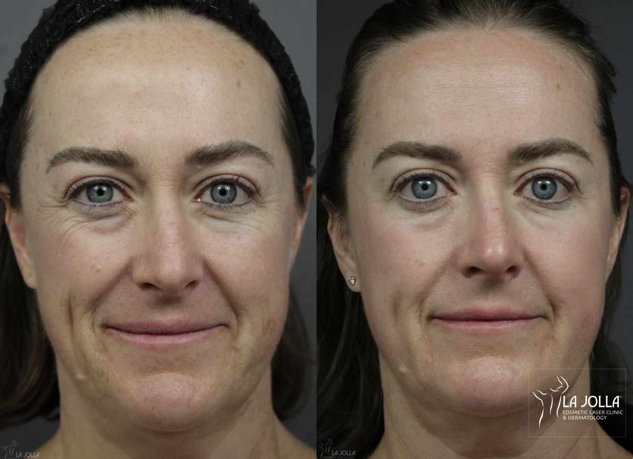 Before and after Fraxel® case 36129