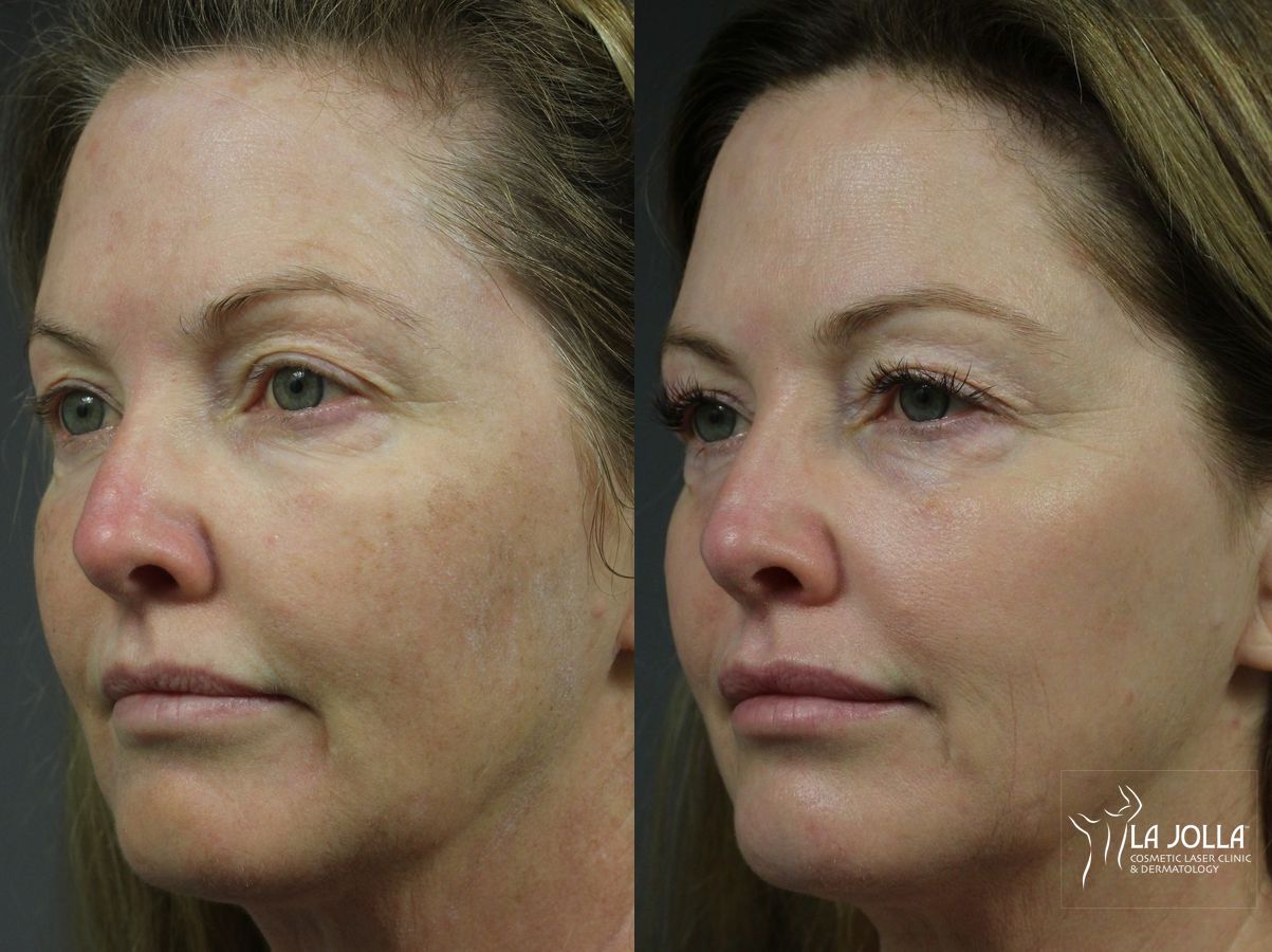 Before and after Fraxel® case 36261