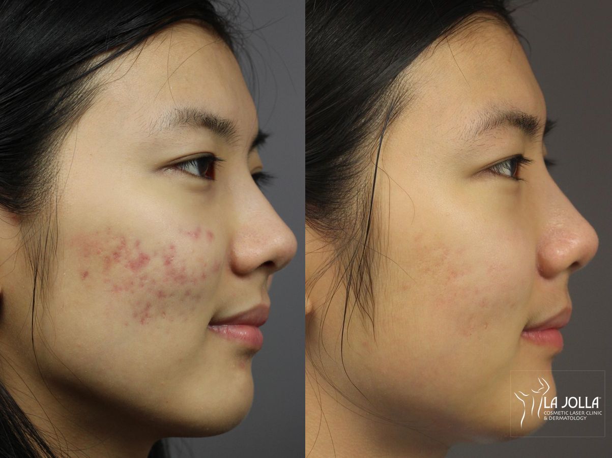 Before and after Fraxel® case 36260