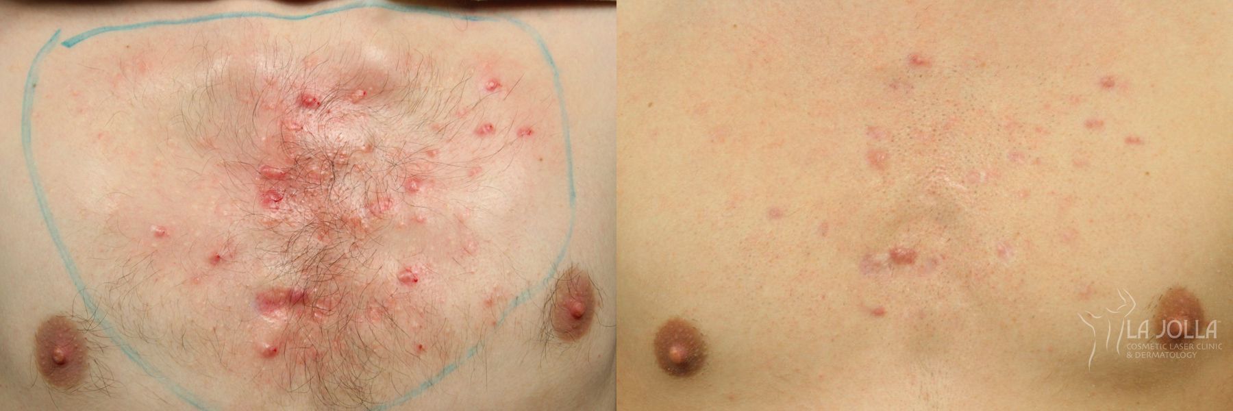 Before and after Fraxel® case 36217